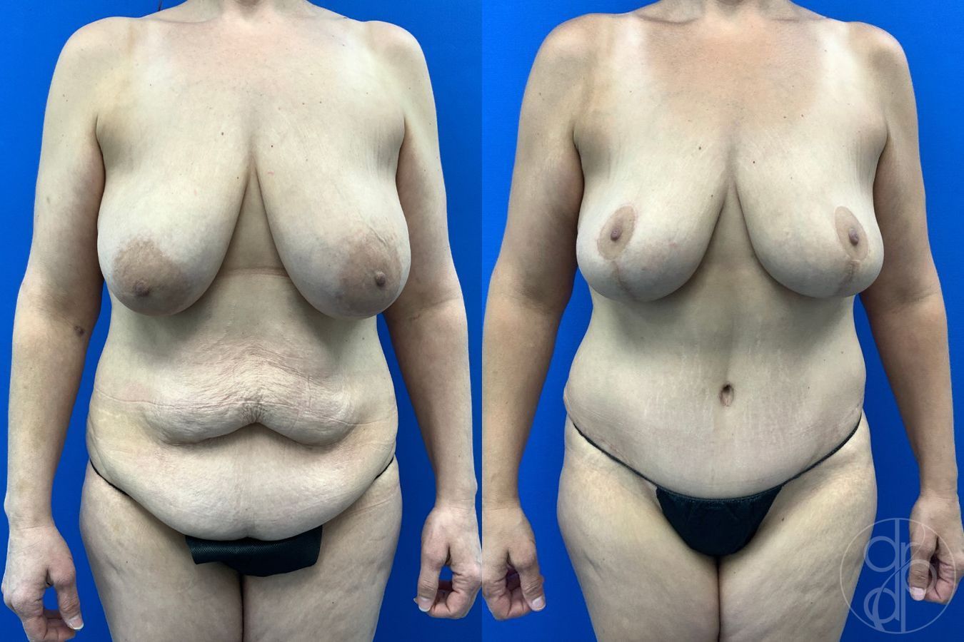 Before and after Mommy Makeover case 43478