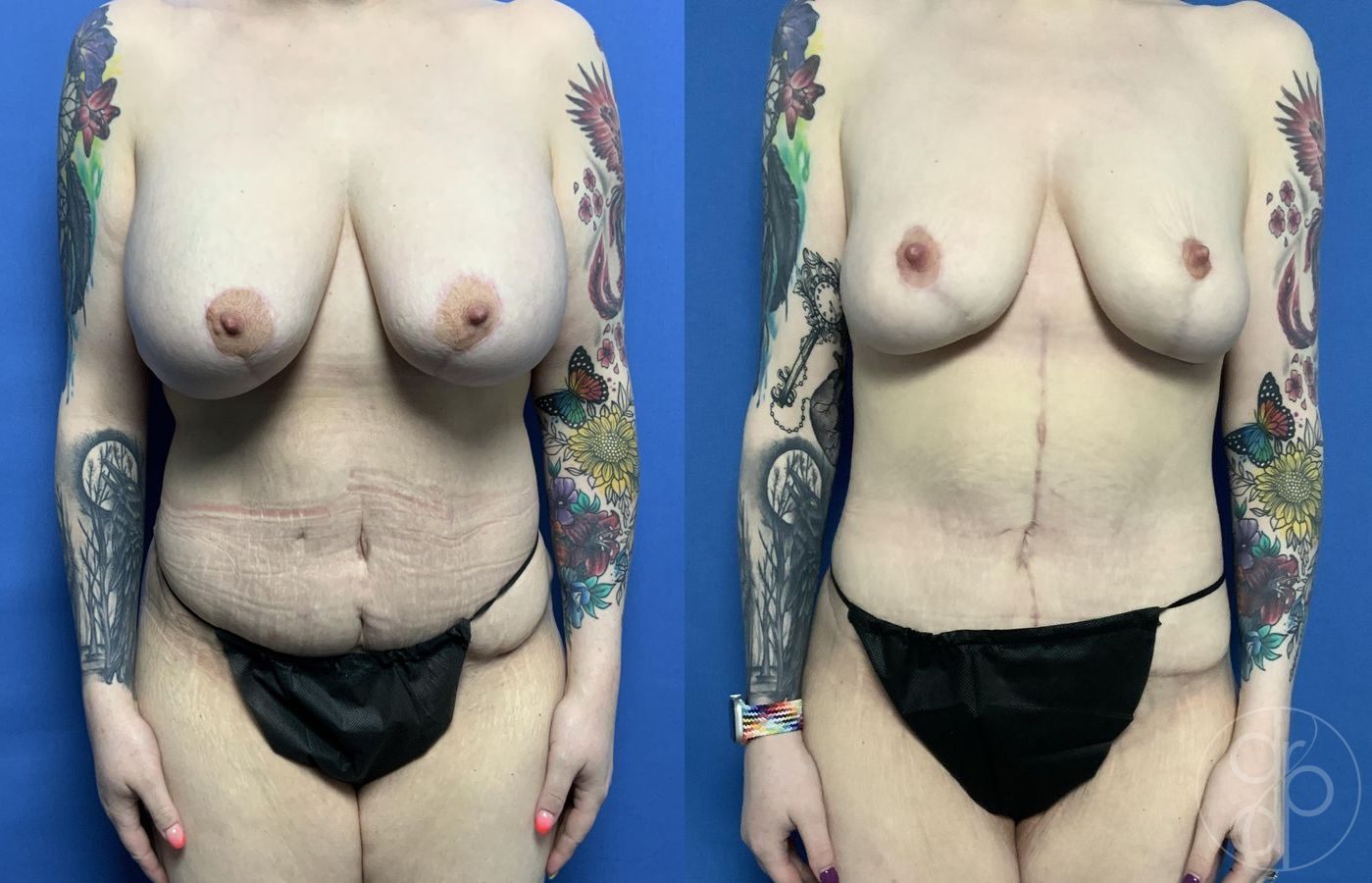 Before and after Mommy Makeover case 29816
