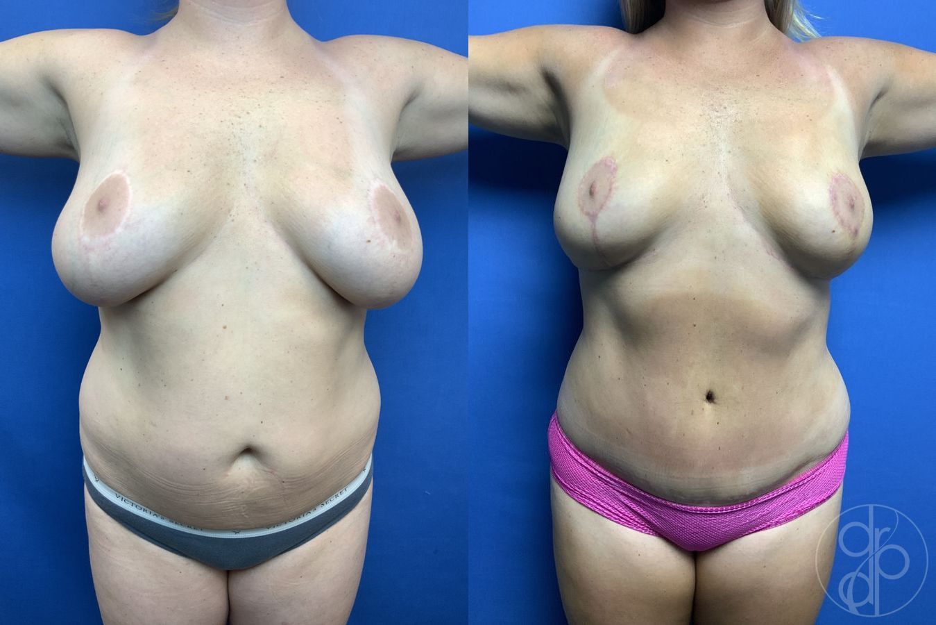 Before and after Mommy Makeover case 29902