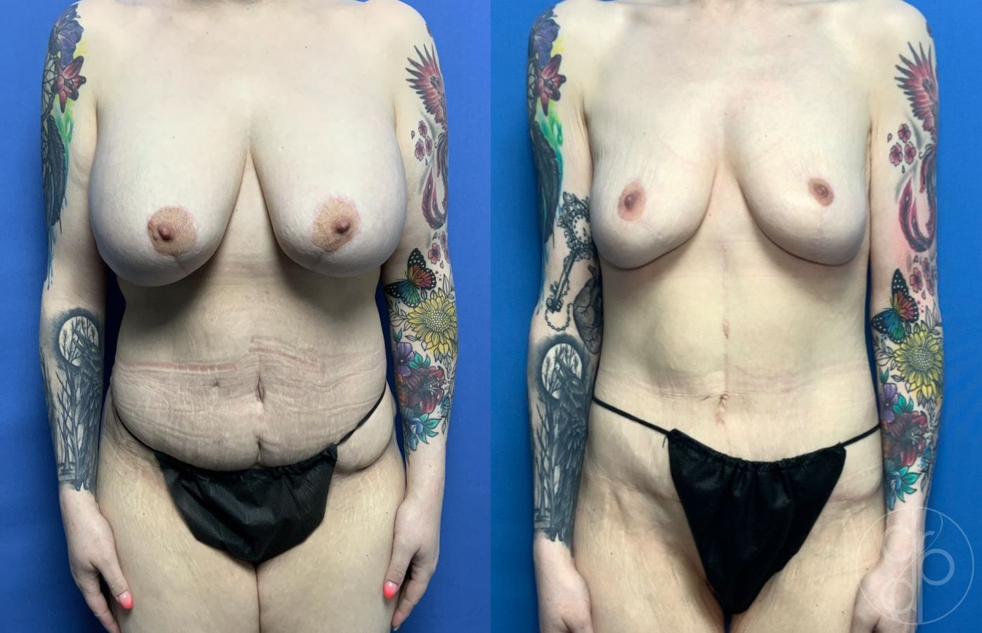 Before and after Breast Implant Removal with Lift case 29816