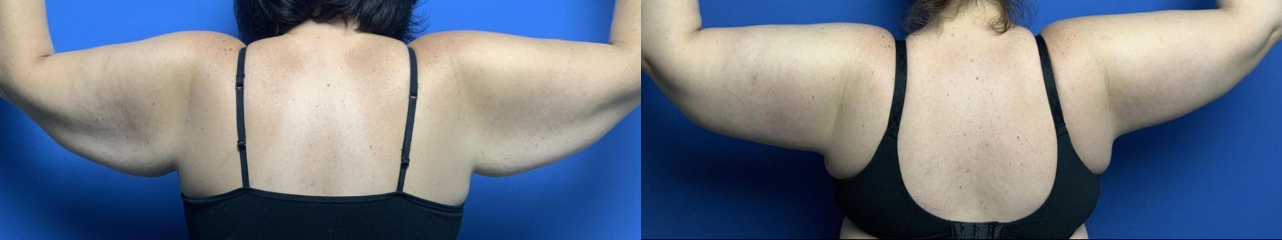 Before and after Mommy Makeover case 29982 - Angle 8