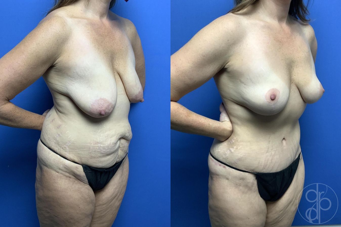 Before and after Mommy Makeover case 29976 - Angle 3