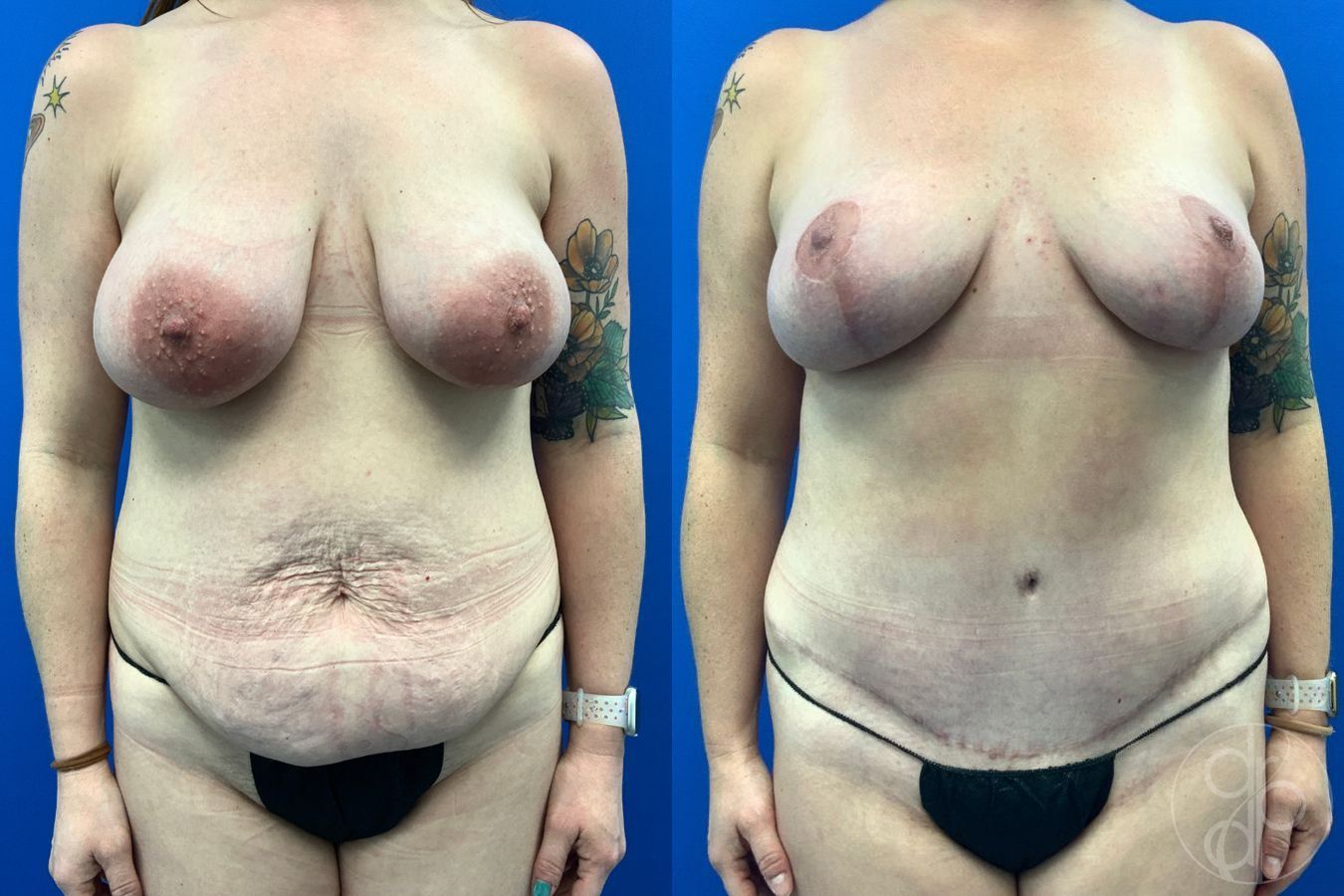 Before and after Mommy Makeover case 43477