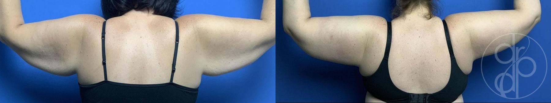Before and after Mommy Makeover case 29982 - Angle 8