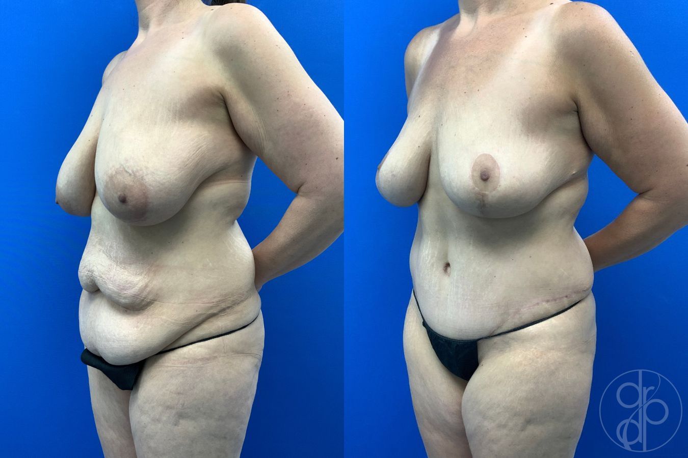 Before and after Mommy Makeover case 43478 - Angle 2