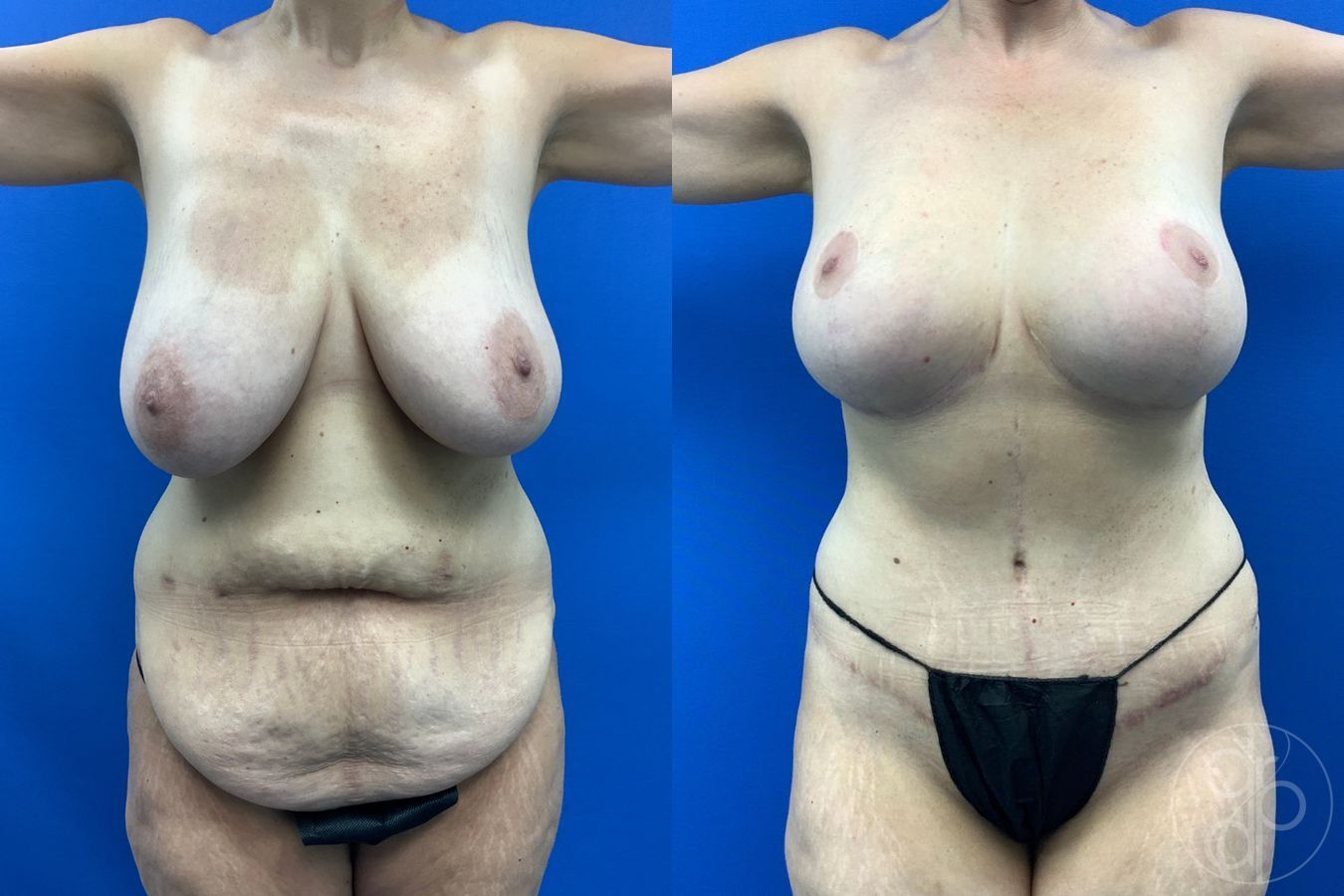 Before and after Breast Reduction case 43471 - Angle 2