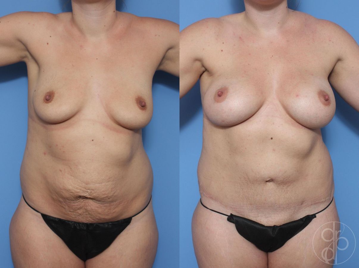 Before and after Mommy Makeover case 29618 - Angle 2