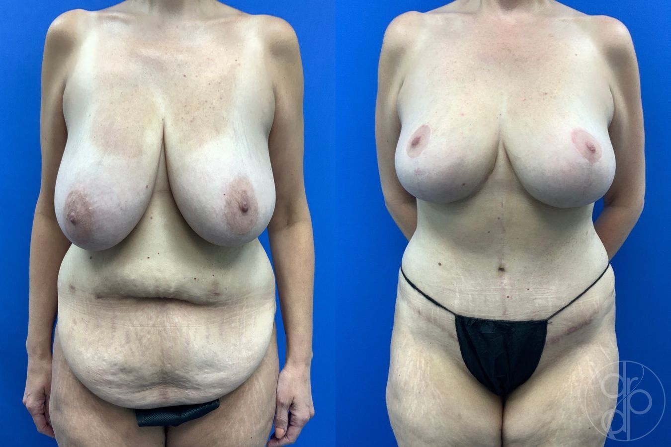 Before and after Breast Reduction case 43471