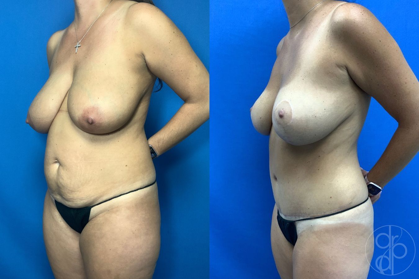Before and after Mommy Makeover case 43479 - Angle 4