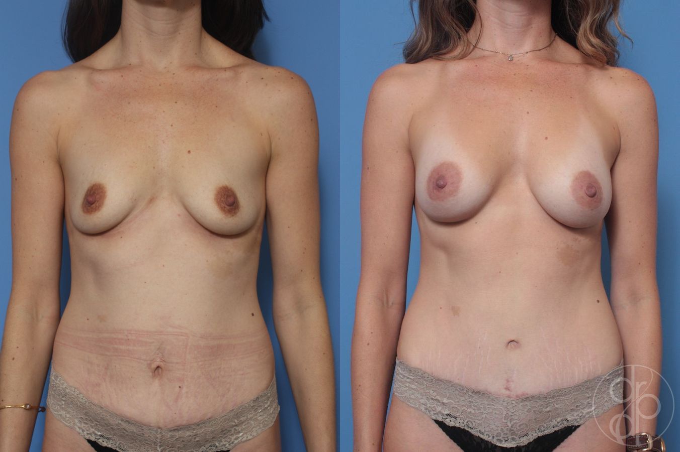 Before and after Mommy Makeover case 29889