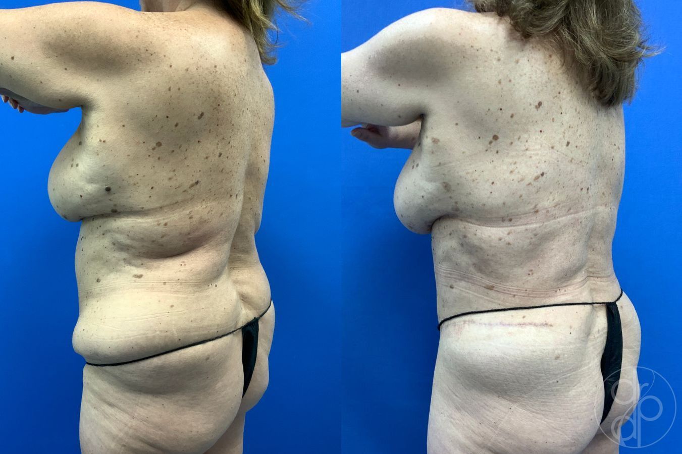 Before and after Mommy Makeover case 46273 - Angle 4