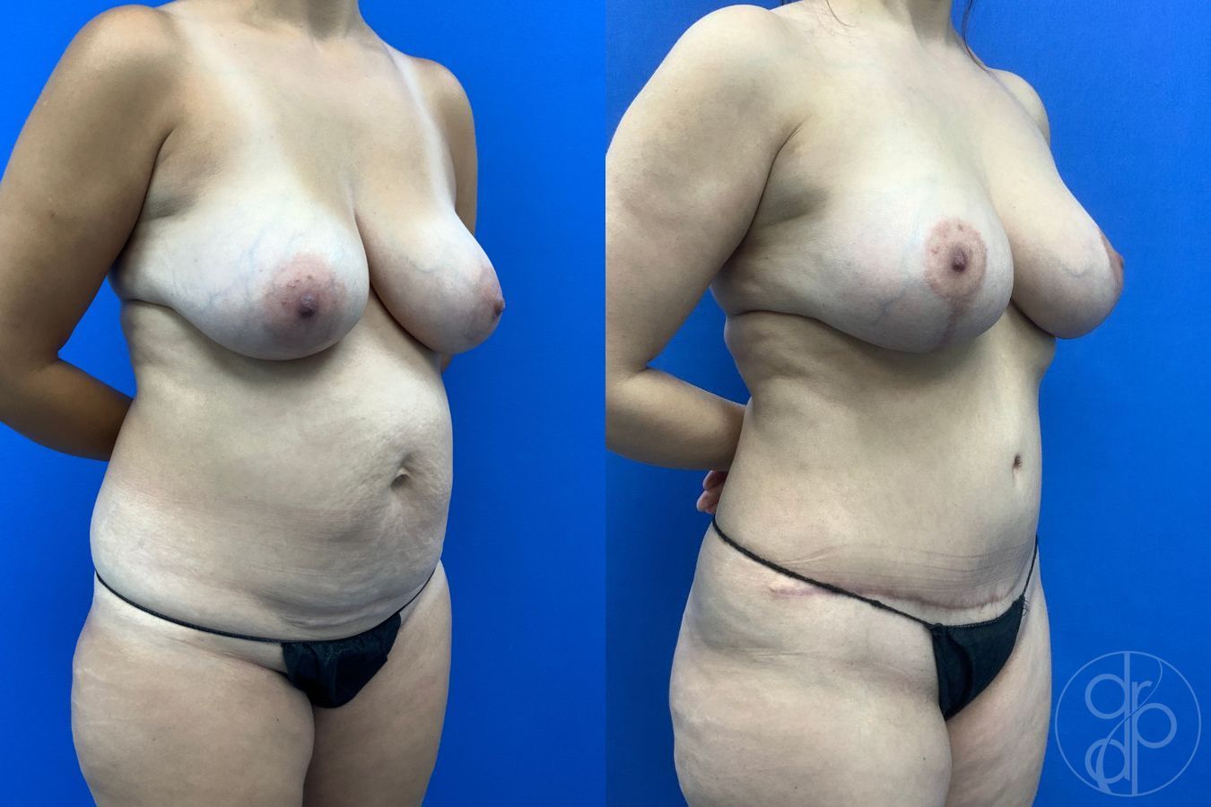 Before and after Abdominoplasty case 43462 - Angle 4