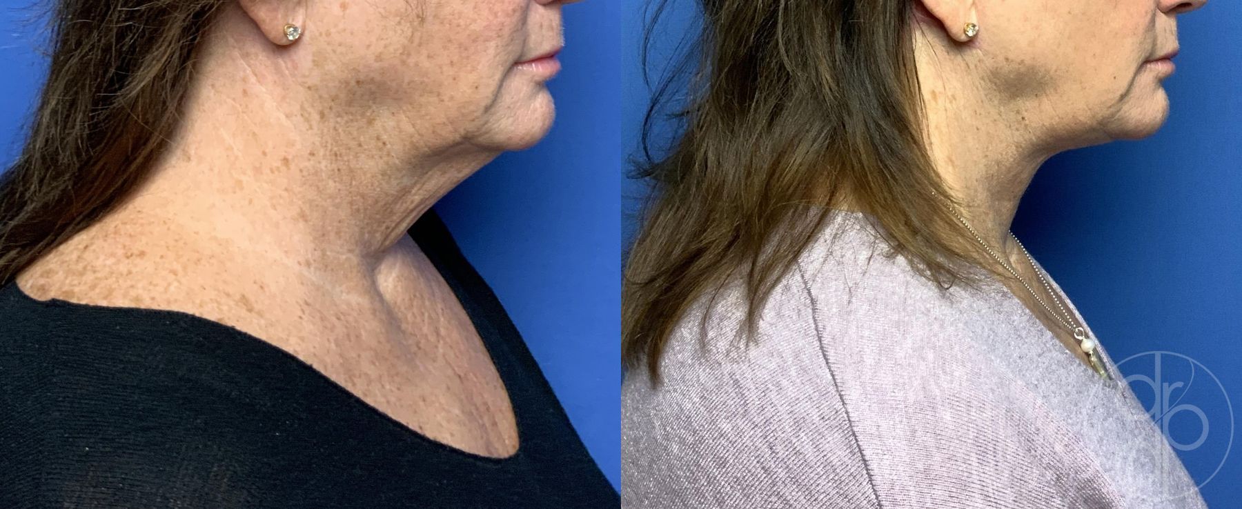 Before and after Neck Lift case 29801 - Angle 2