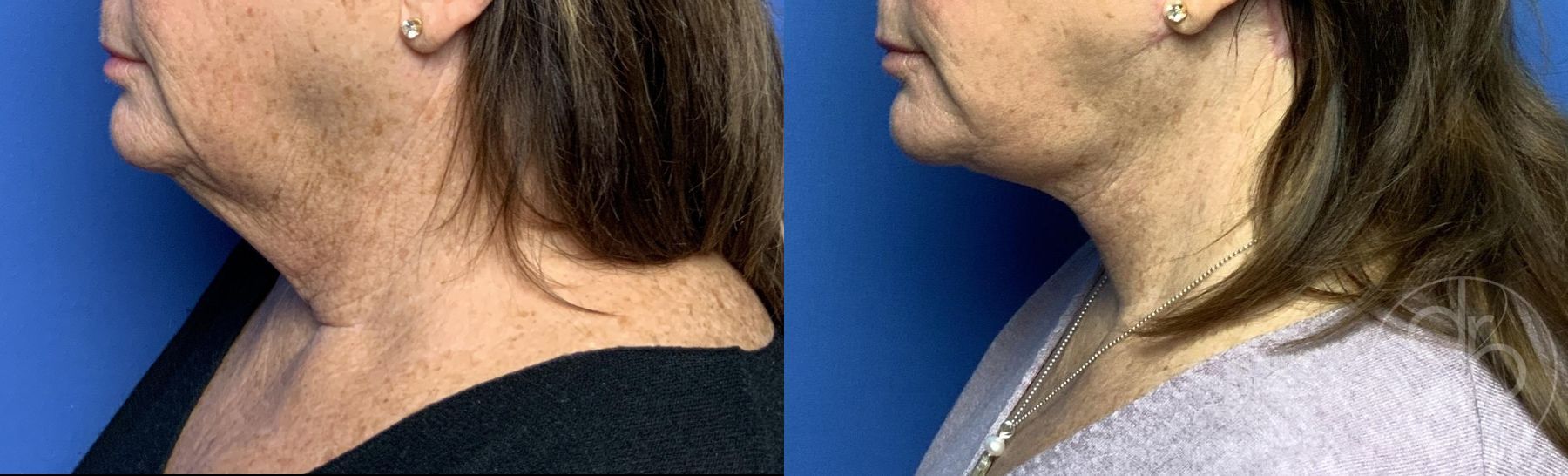 Before and after Neck Lift case 29801 - Angle 4