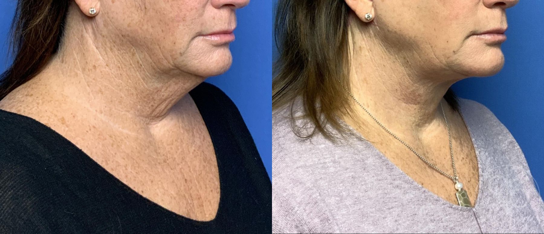 Before and after Neck Lift case 29801
