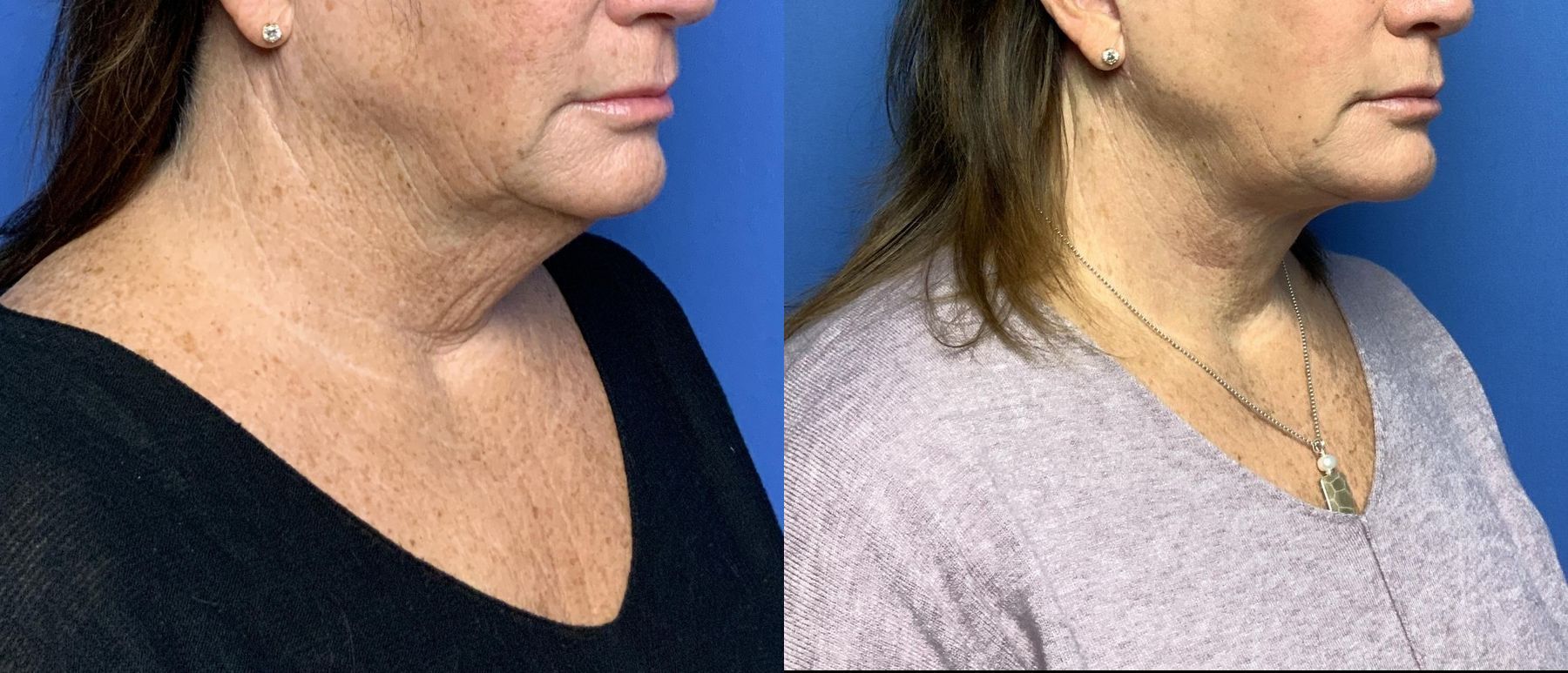 Before and after Neck Lift case 29801