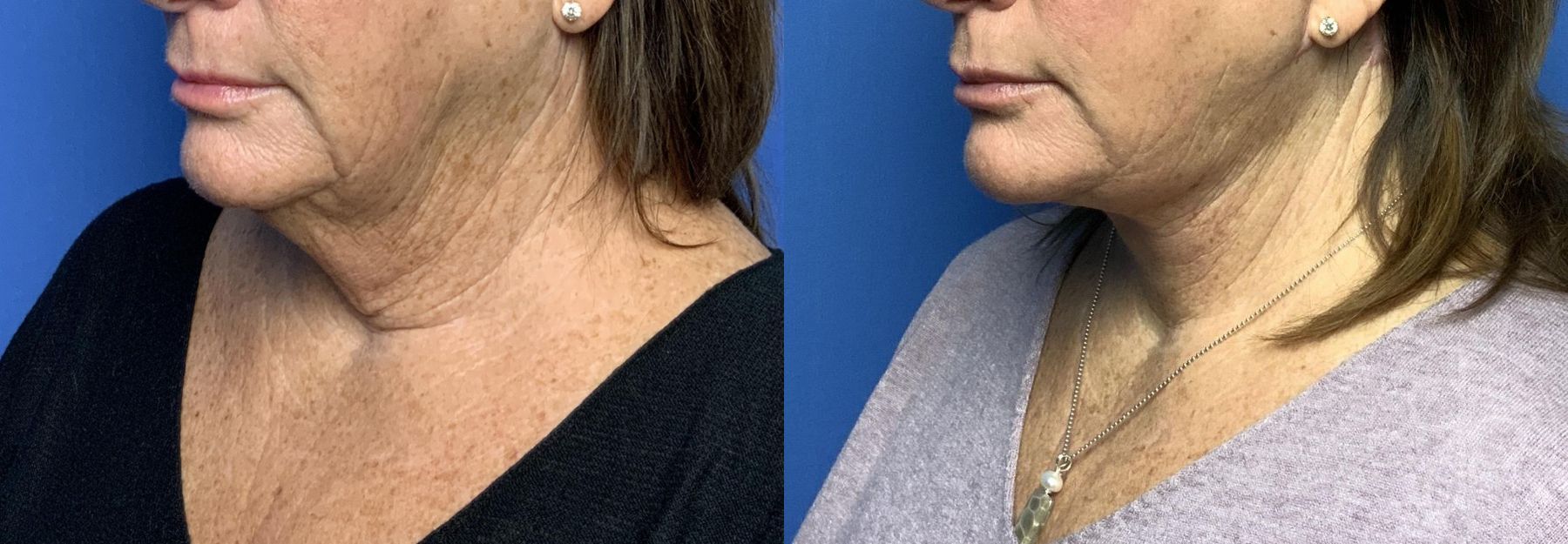 Before and after Neck Lift case 29801 - Angle 3