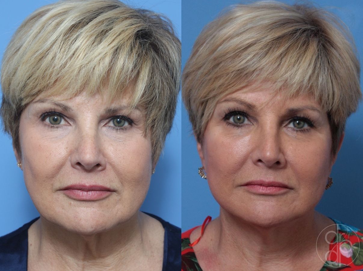 Before and after Neck Lift case 29812