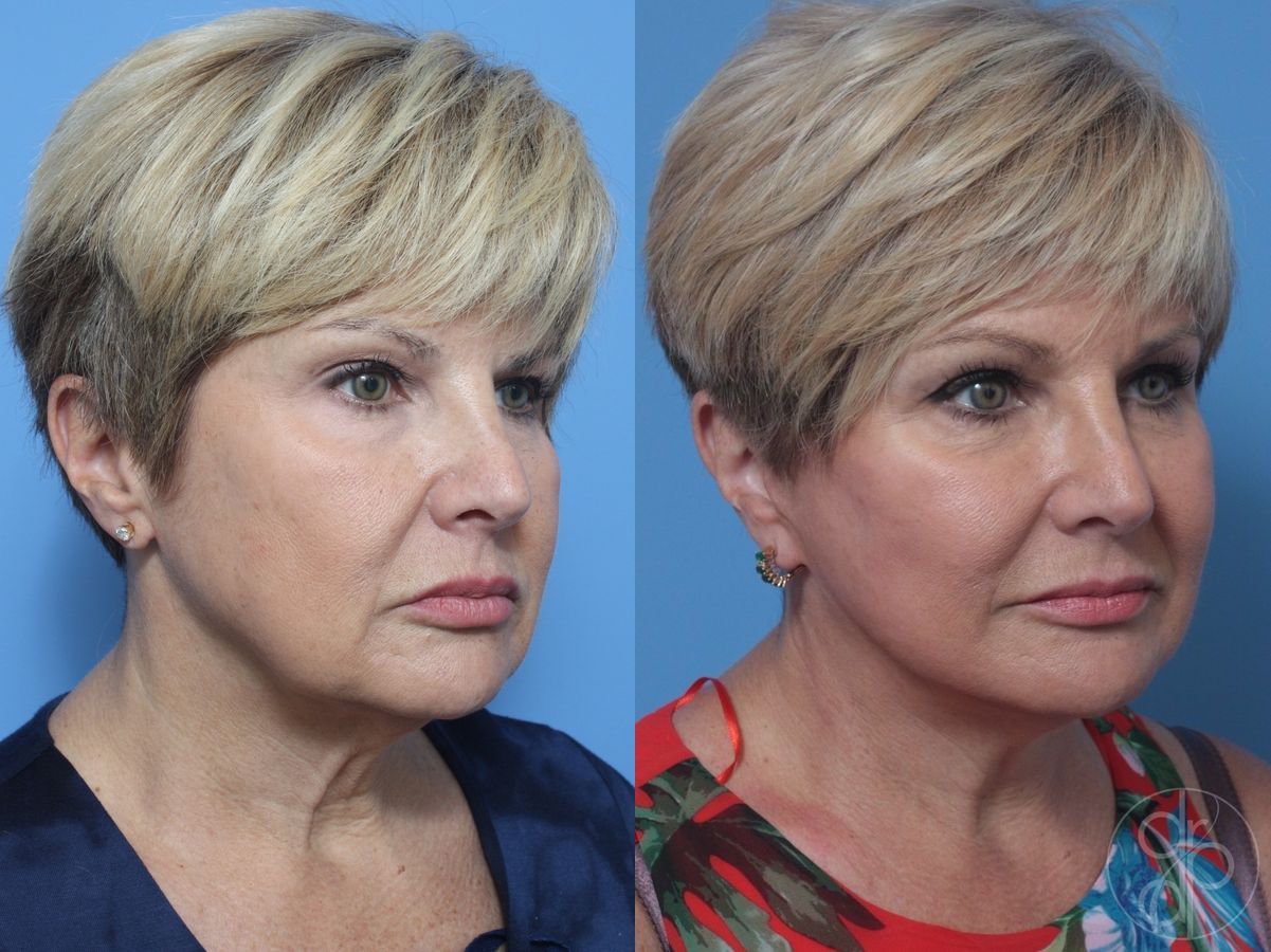 Before and after Neck Lift case 29812 - Angle 2