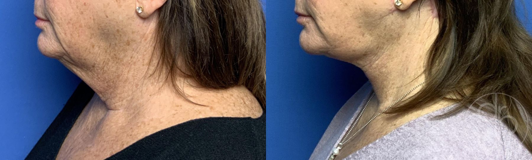 Before and after Neck Lift case 29801 - Angle 4