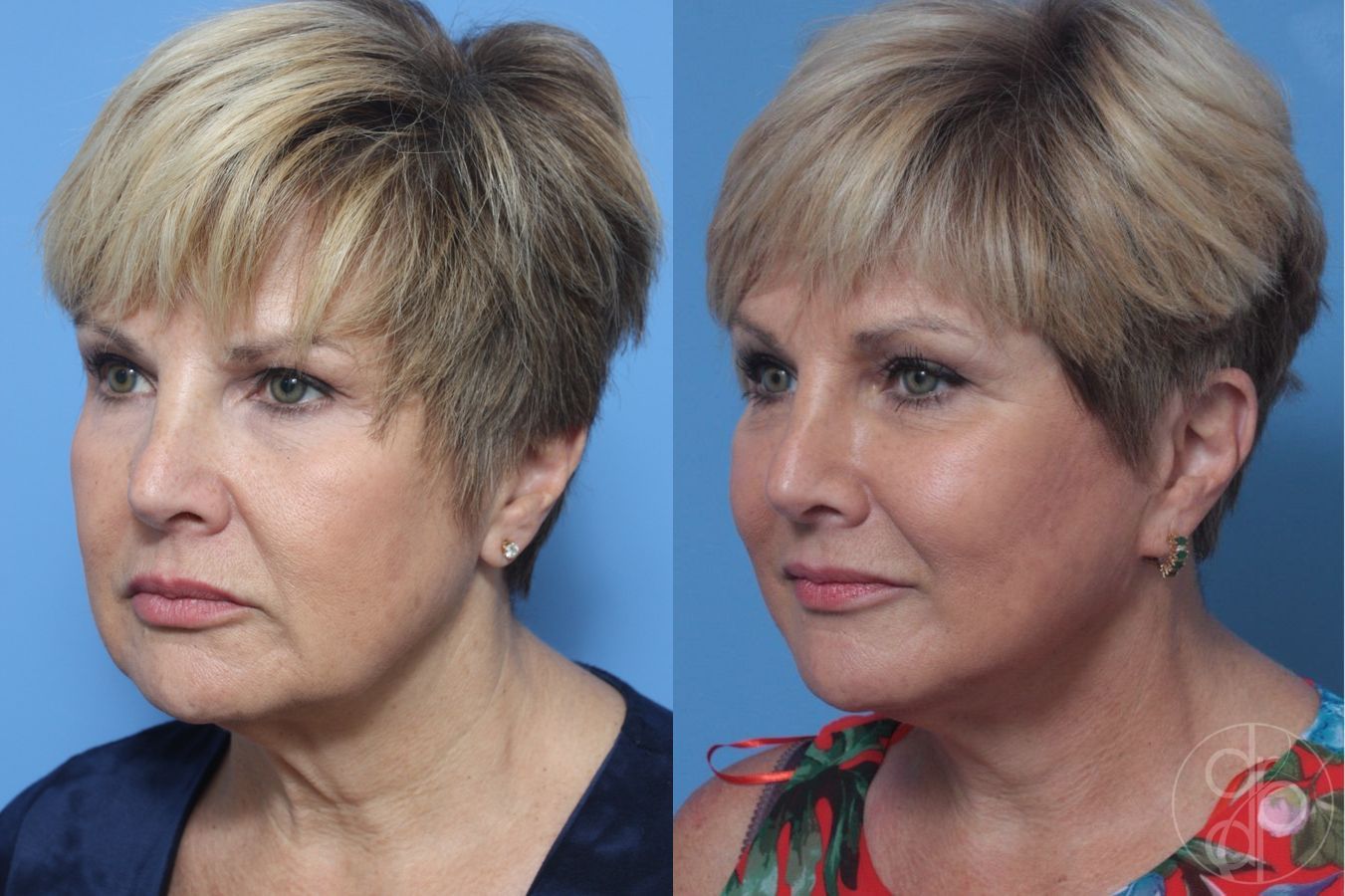 Before and after Neck Lift case 29812 - Angle 3