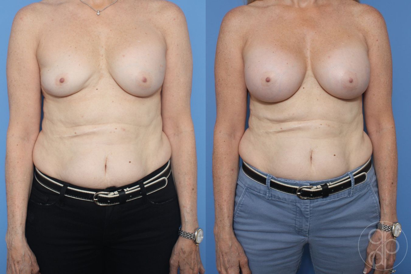Before and after Remove & Replace case 29857