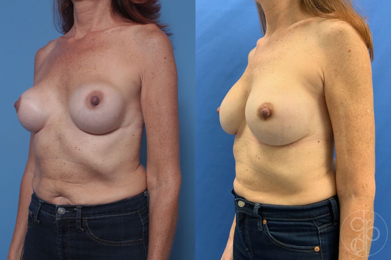 Before and after Remove & Replace case 29846 - Angle 3