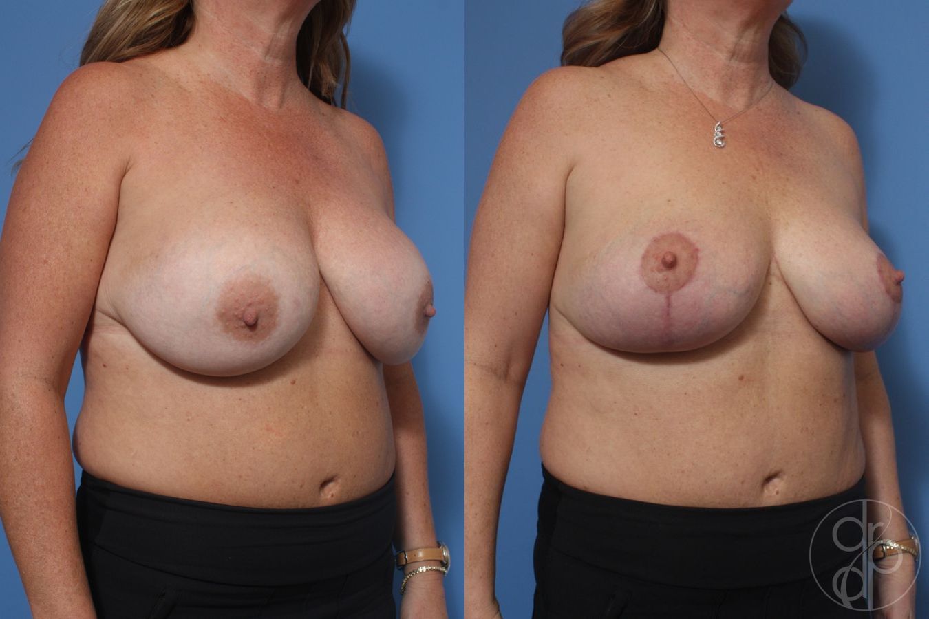 Before and after Remove & Replace case 29757 - Angle 2