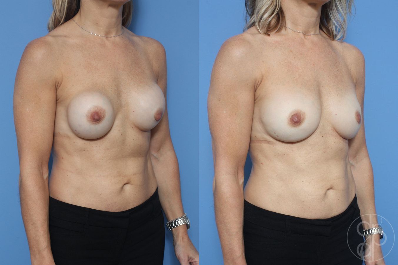 Remove & Replace - Thumbnail 2