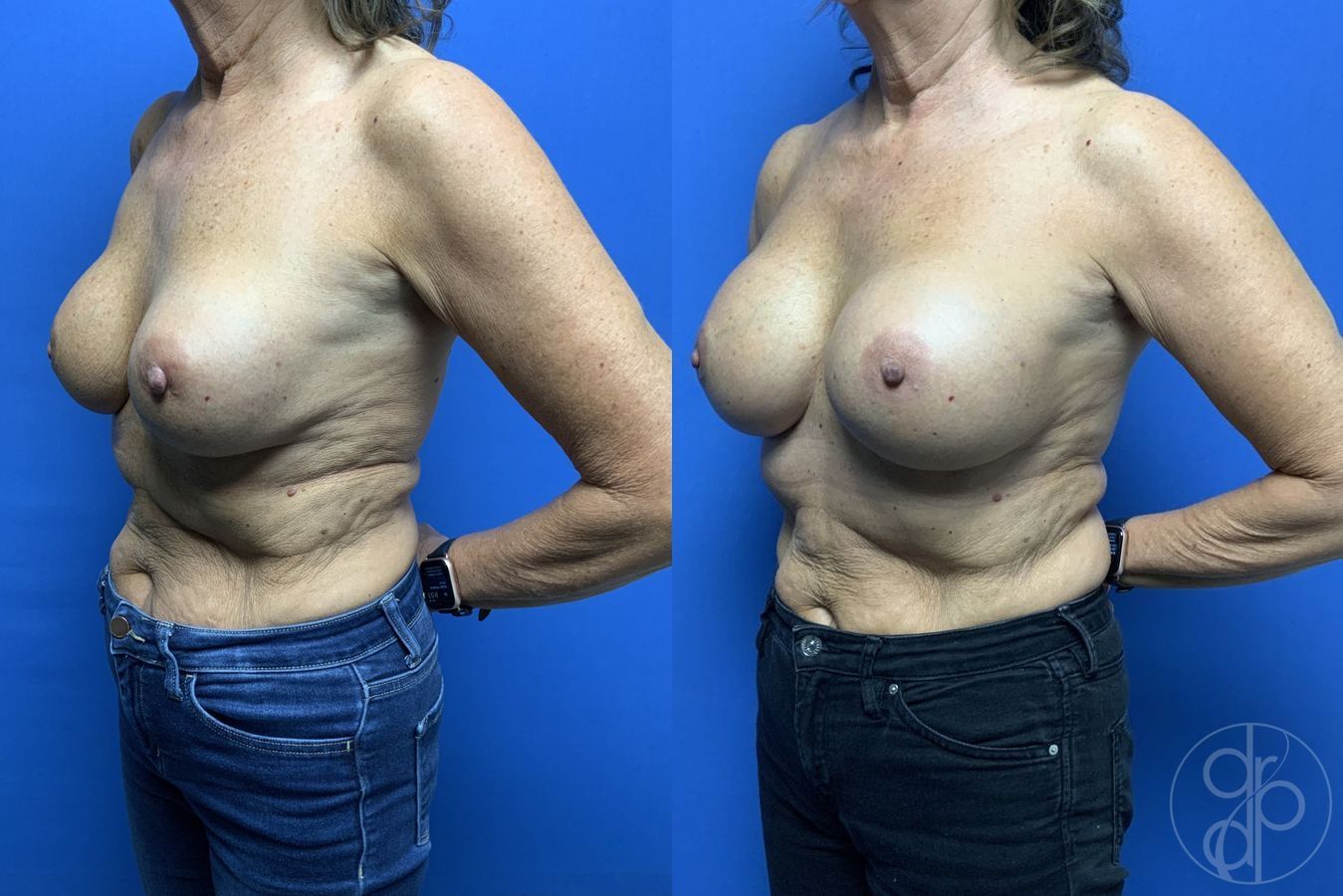 Remove & Replace - Thumbnail 3