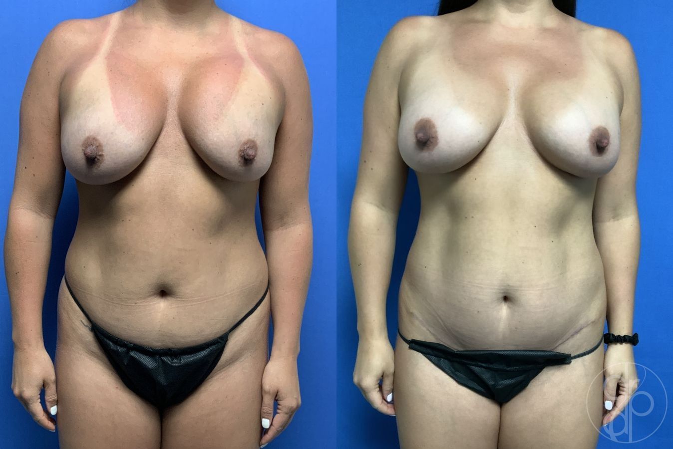 Before and after Remove & Replace case 29713