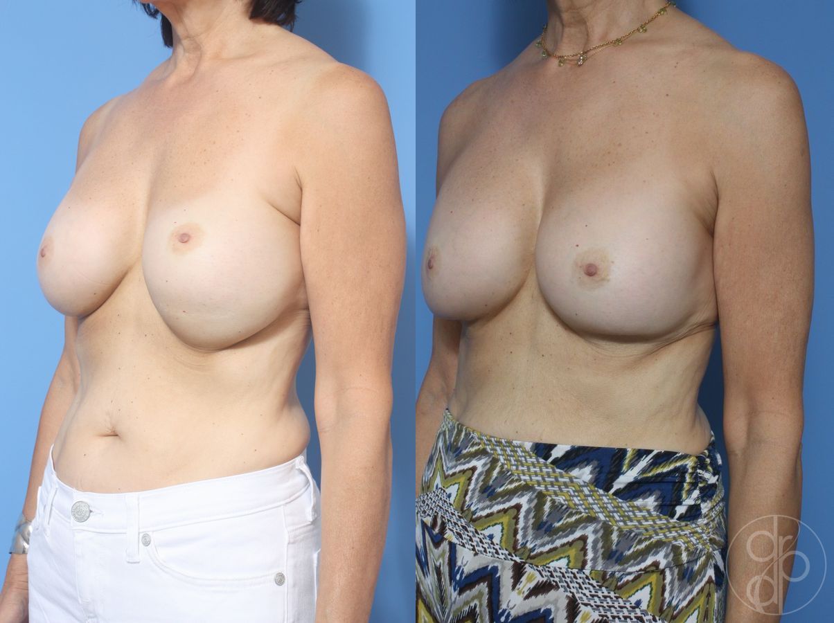Before and after Remove & Replace case 29851 - Angle 3