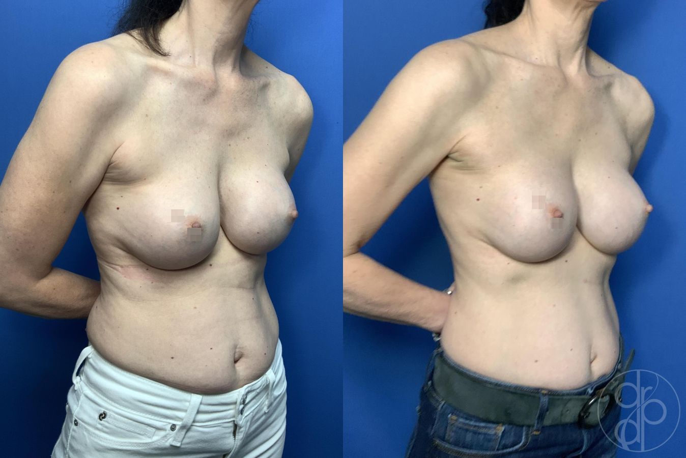 Before and after Remove & Replace case 30001 - Angle 3