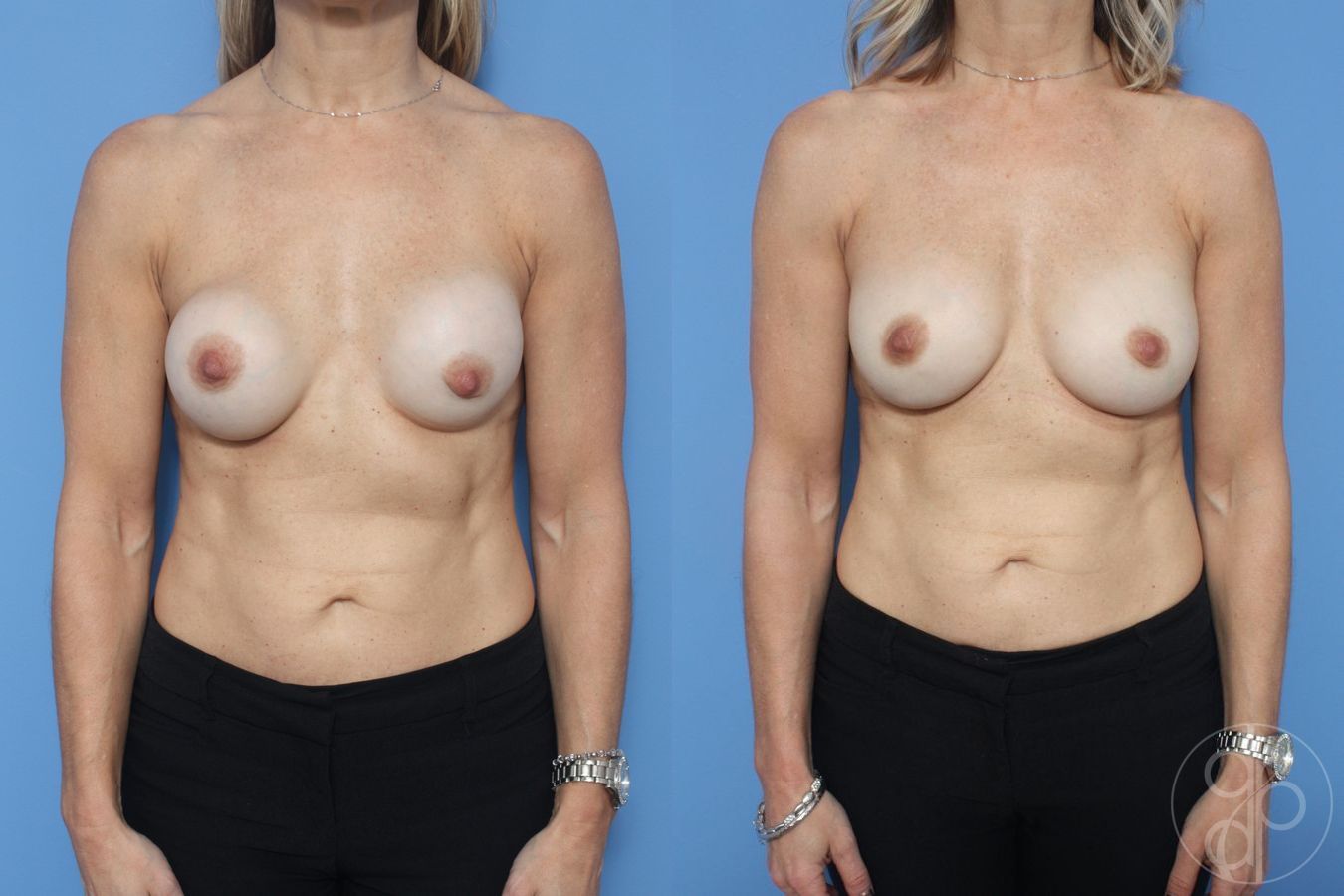 Before and after Remove & Replace case 29873