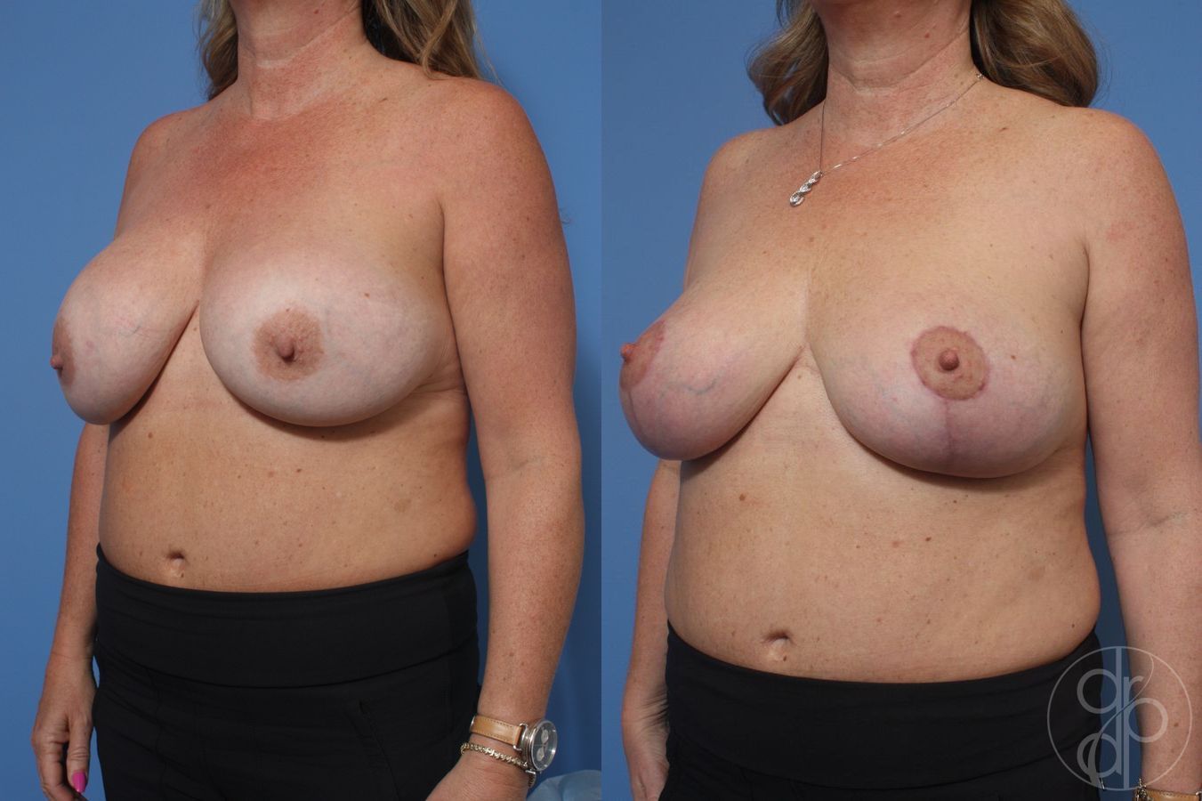 Before and after Remove & Replace case 29757 - Angle 3