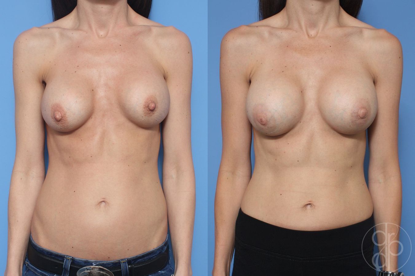 Before and after Remove & Replace case 29859
