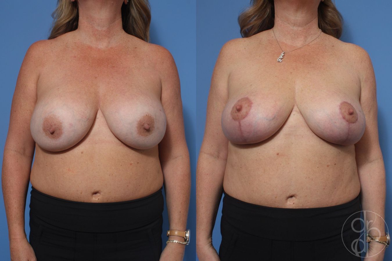 Before and after Remove & Replace case 29757