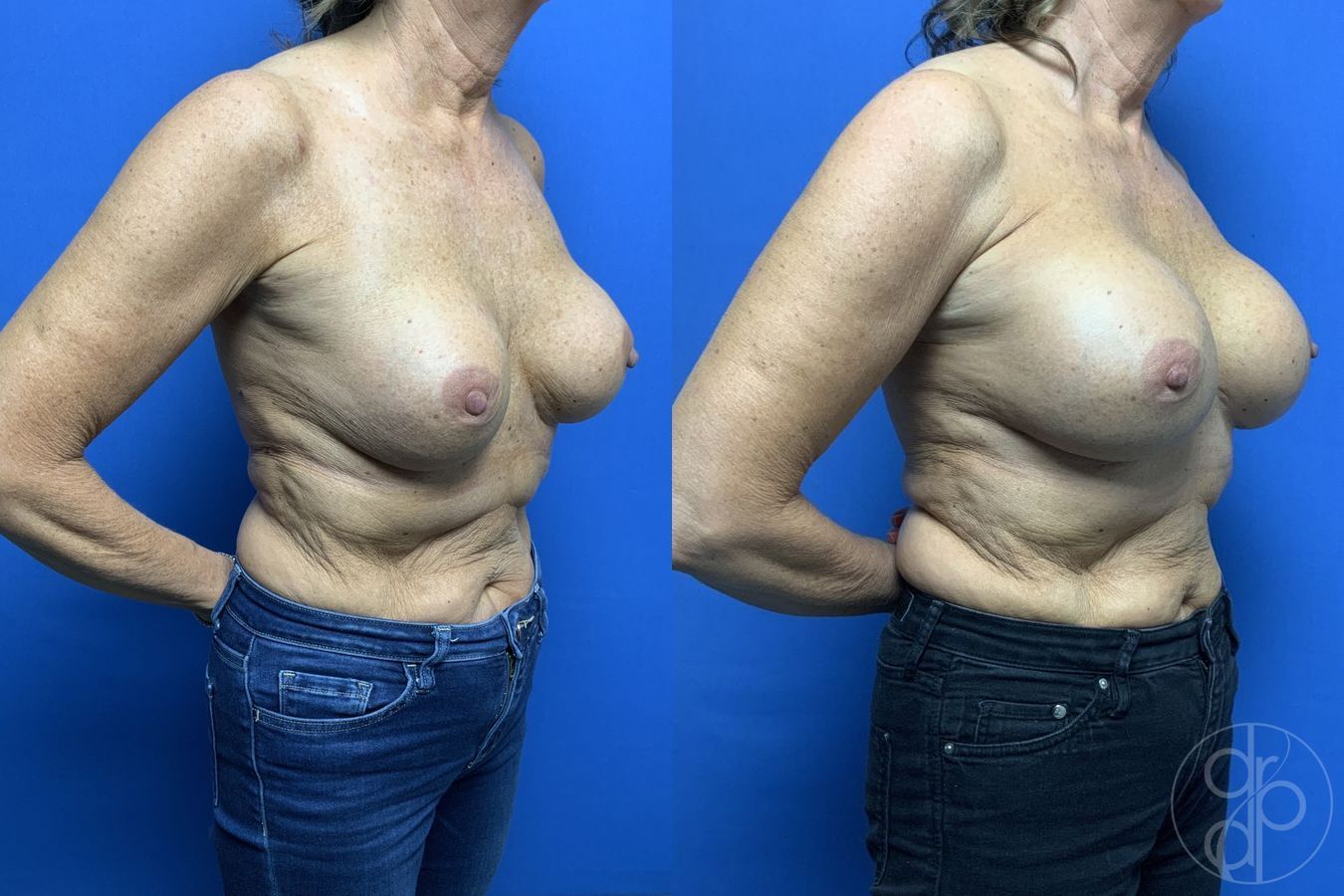 Before and after Remove & Replace case 29878 - Angle 2