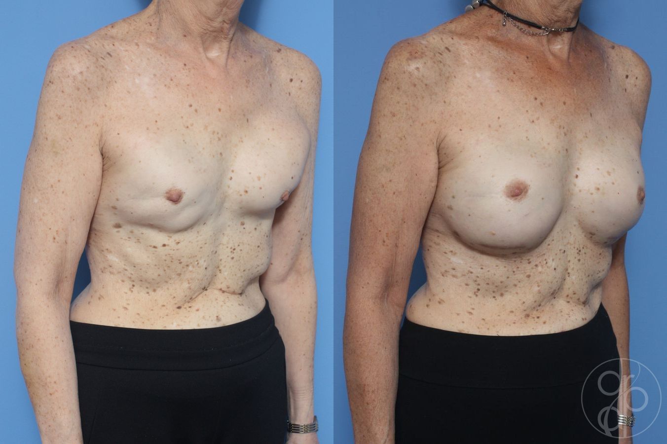Before and after Remove & Replace case 29891 - Angle 2