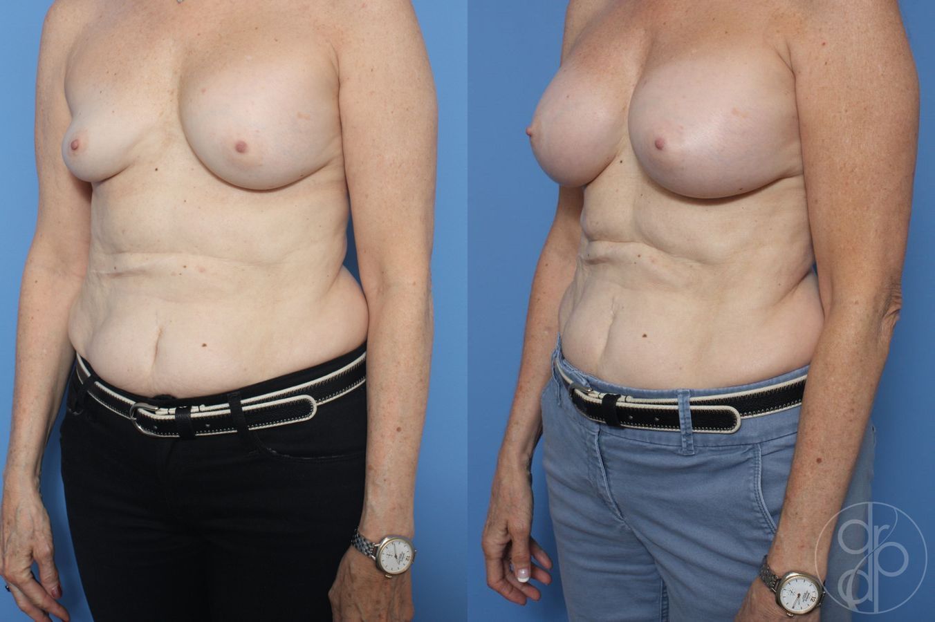 Before and after Remove & Replace case 29857 - Angle 3