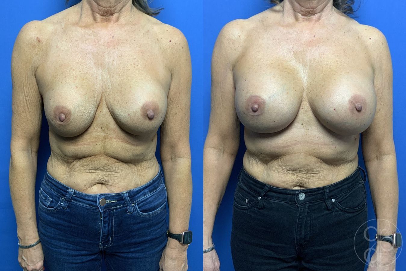 Before and after Remove & Replace case 29878