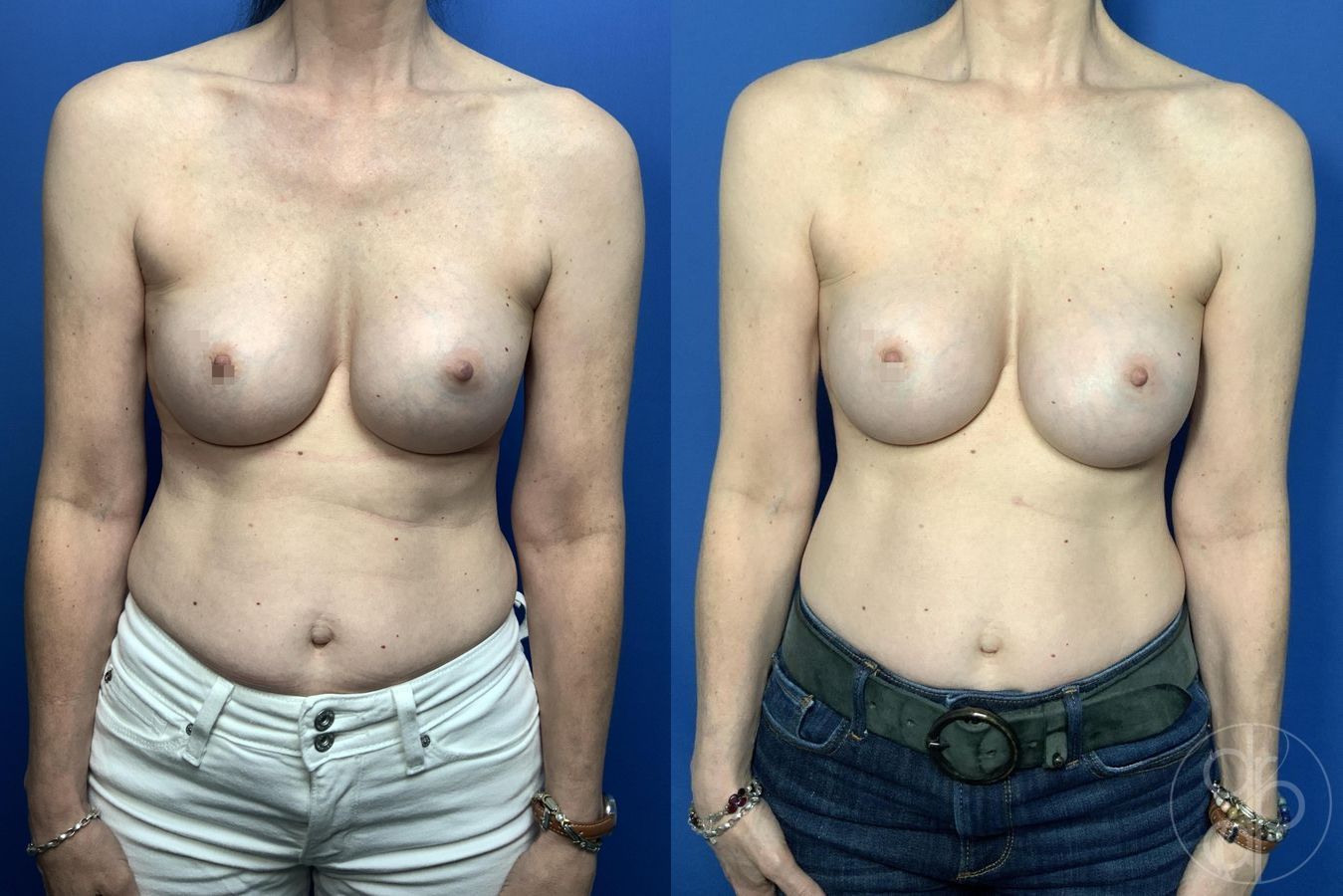 Before and after Remove & Replace case 30001