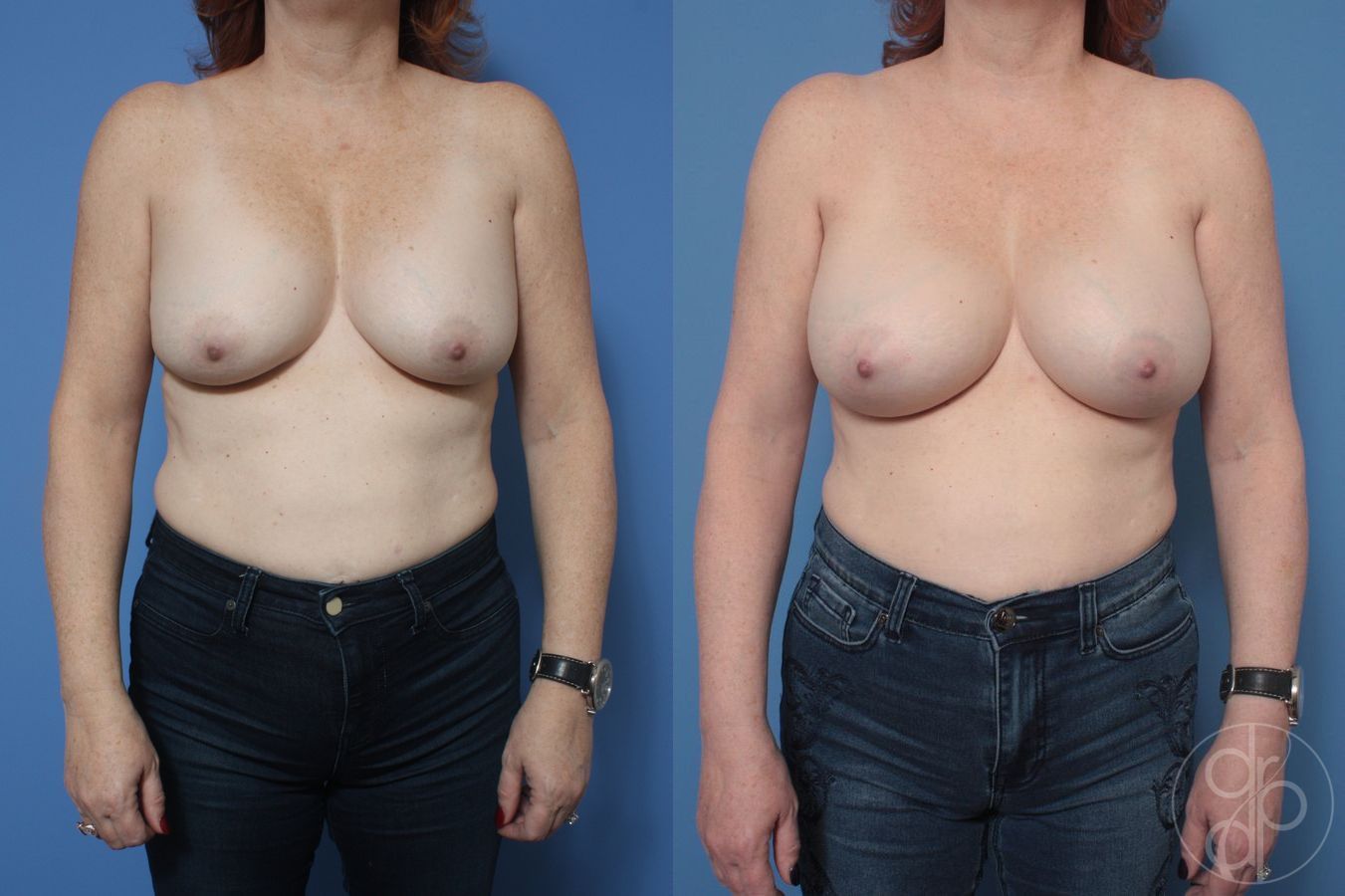 Before and after Remove & Replace case 29867