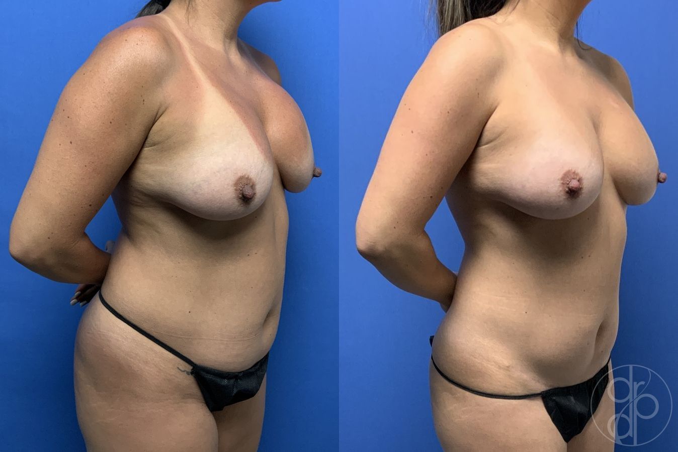 Before and after Remove & Replace case 29713 - Angle 3