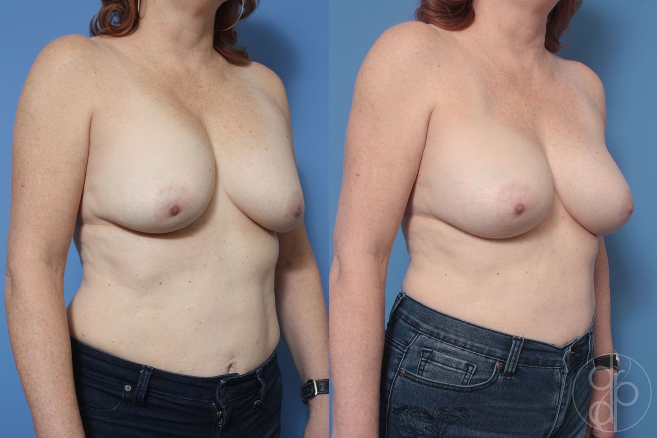 Before and after Remove & Replace case 29867 - Angle 3