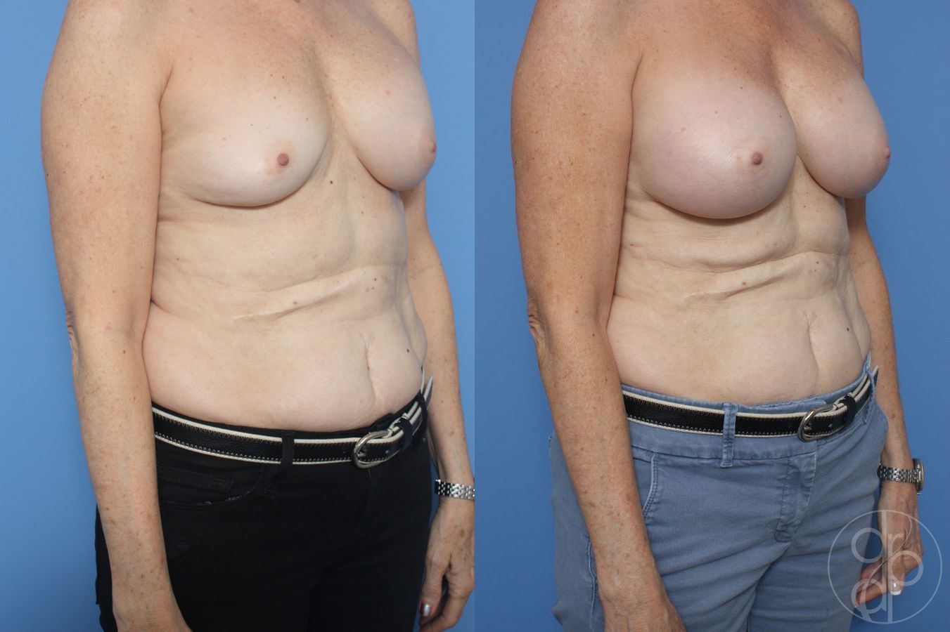 Before and after Remove & Replace case 29857 - Angle 2