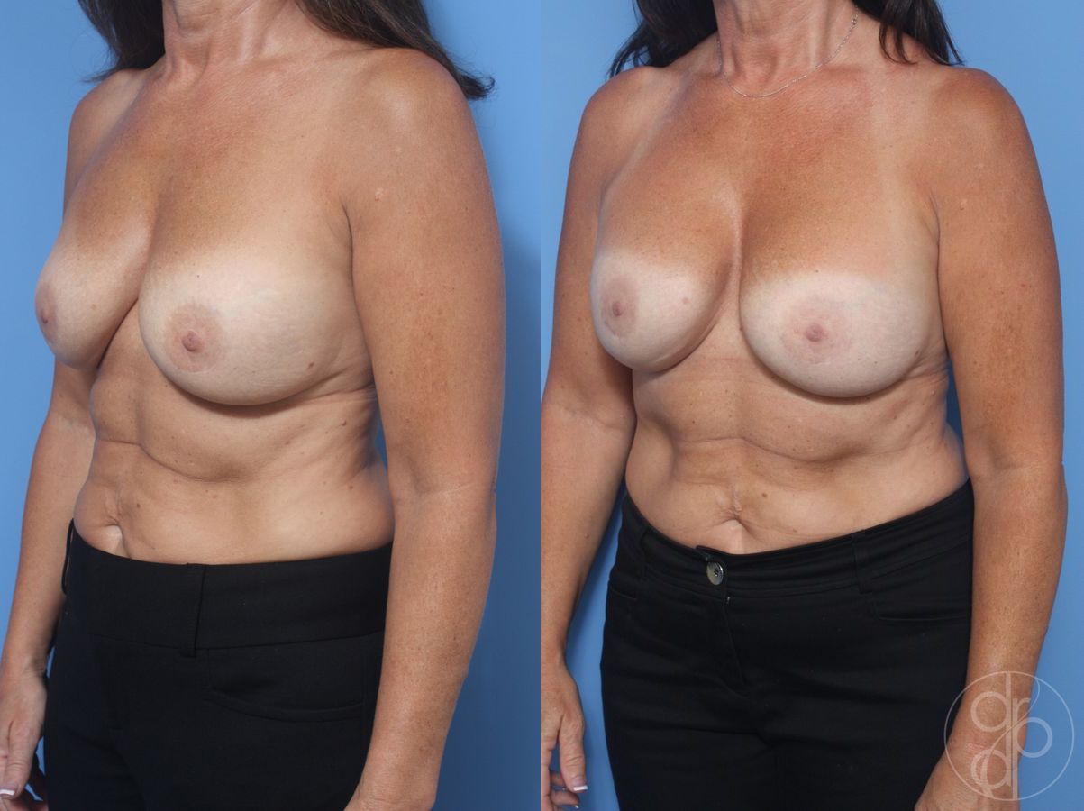 Before and after Remove & Replace case 29844 - Angle 2