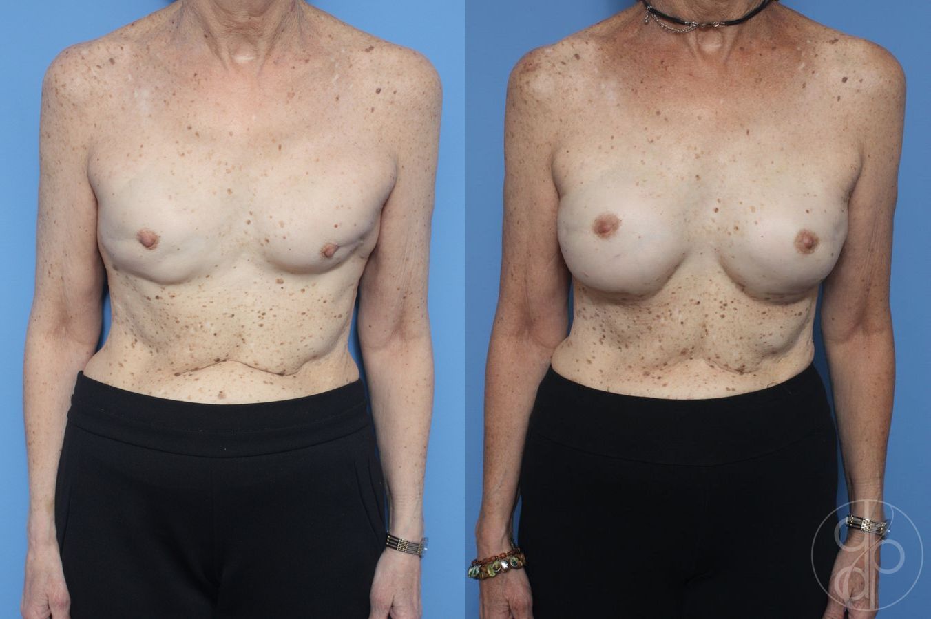 Before and after Remove & Replace case 29891