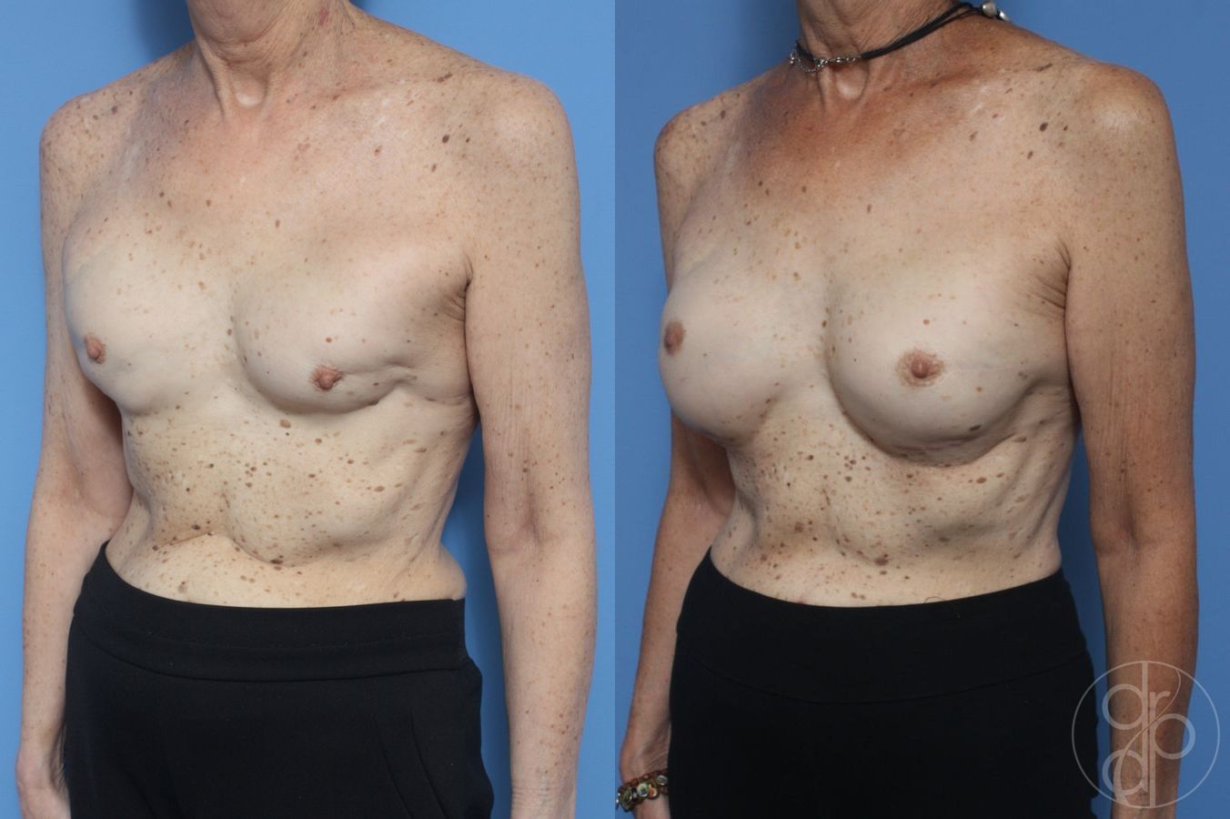 Before and after Remove & Replace case 29891 - Angle 3