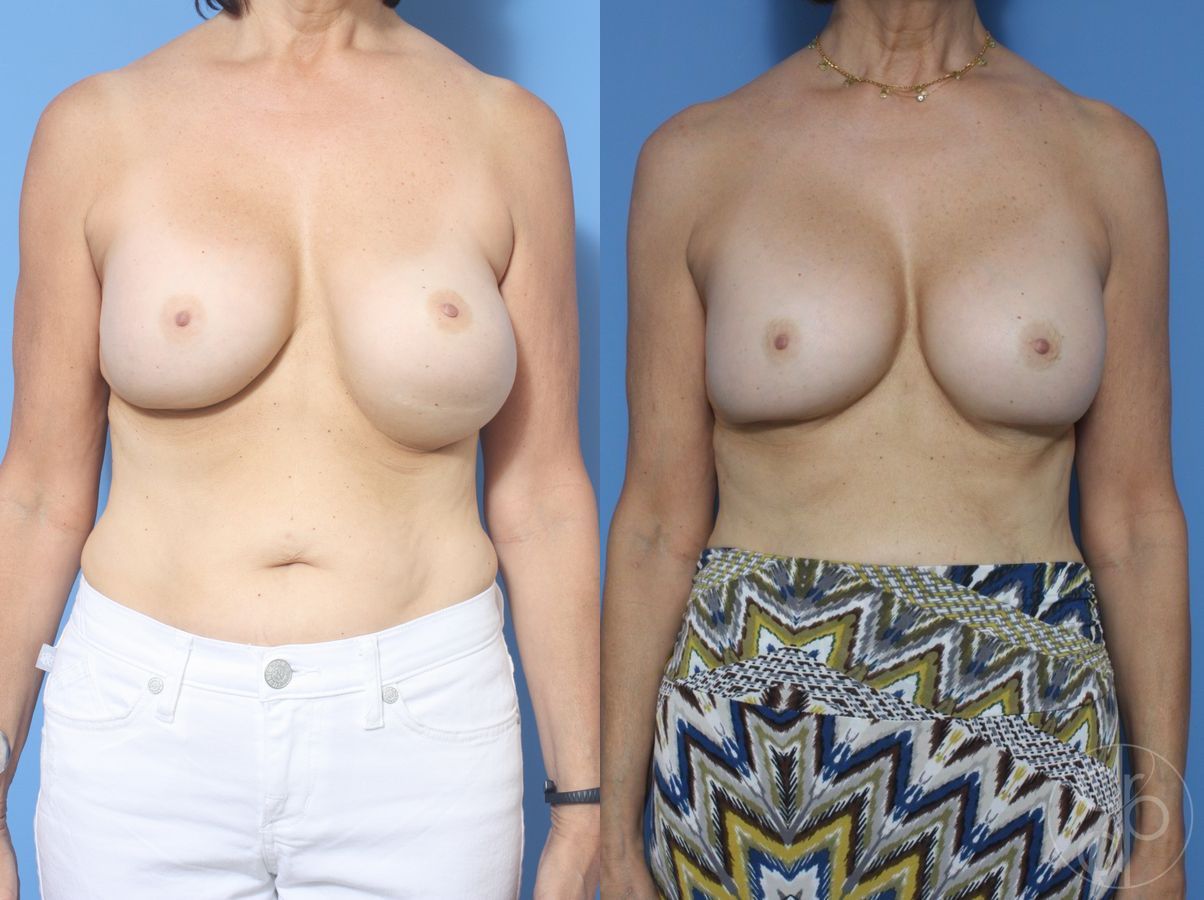 Before and after Remove & Replace case 29851